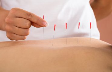 Acupuncture, Acupressure & Dry Needling Therapy