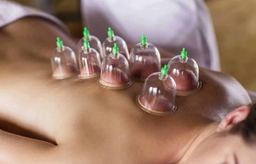 Cupping Therapy