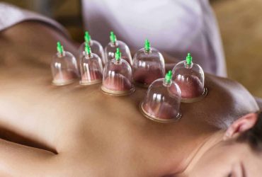 Cupping Therapy